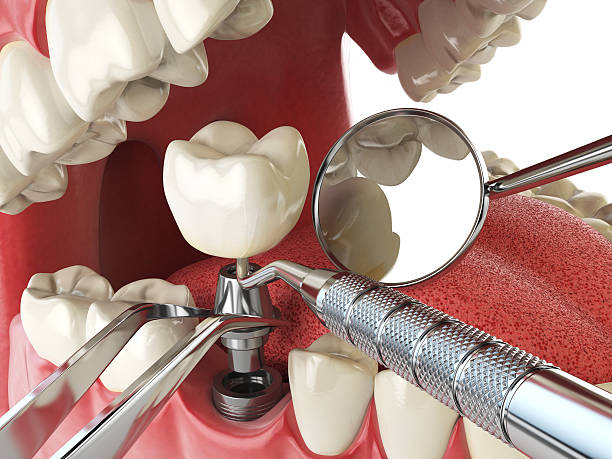 Best Emergency Treatment for Dental Infections or Abscesses in North Miami Beach, FL
